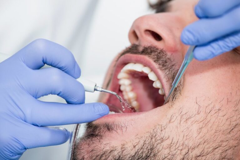 How To Remove Tartar From Teeth Without Dentist