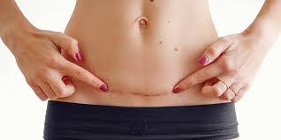 How To Keep C-section Incision Dry When Overweight