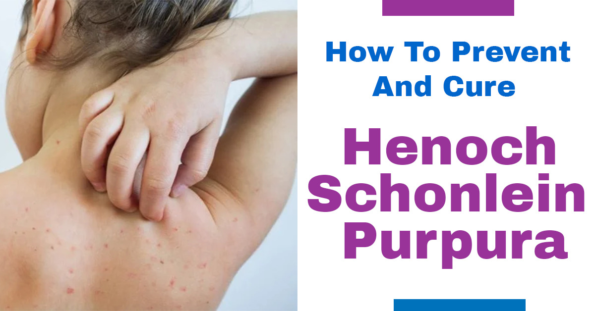 How To Prevent And Cure Henoch Schonlein Purpura