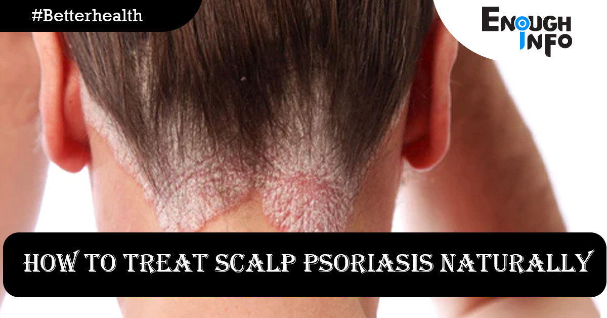How To Treat Scalp Psoriasis Naturally