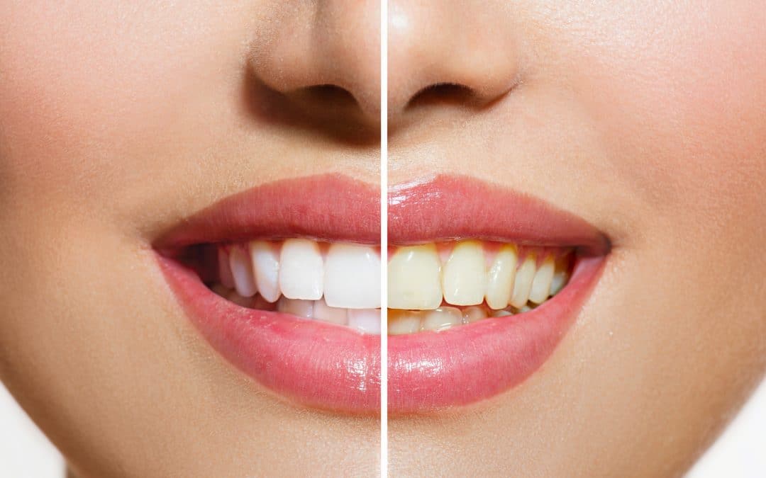 How to Whiten bonded Teeth (All you need to know)