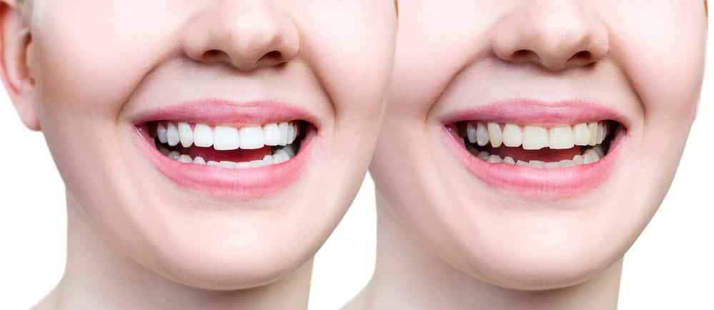 How to Whiten bonded Teeth (All you need to know)
