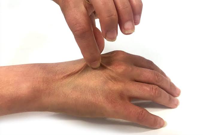 How to tell if you're dehydrated (Finger Test)