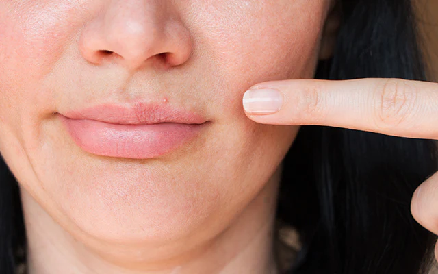 How to get rid of small bumps on the lips (The Ultimate Guide)